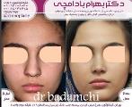 هزینه عمل بینی